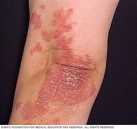 Psoriasis   Symptoms and causes   Mayo Clinic