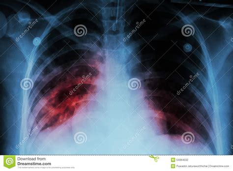 Pulmonary Tuberculosis   TB   : Chest X ray Show Alveolar ...