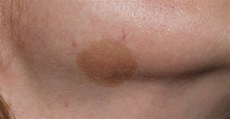 Q switched laser for age spots removal: face, neck, back ...