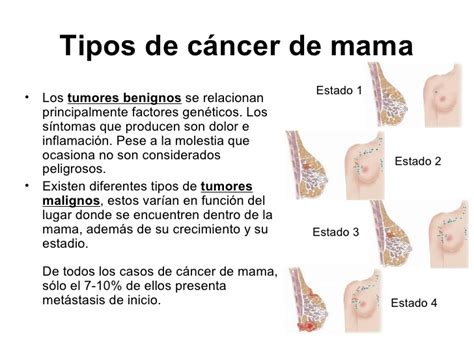 Qué es el cáncer de mama