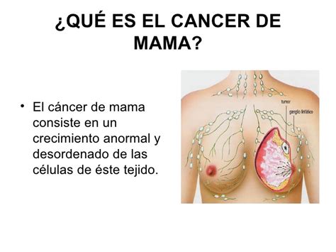 Qué es el cáncer de mama