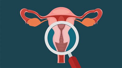 ¿Qué es el Cáncer de ovario? Síntomas   Roche Pacientes