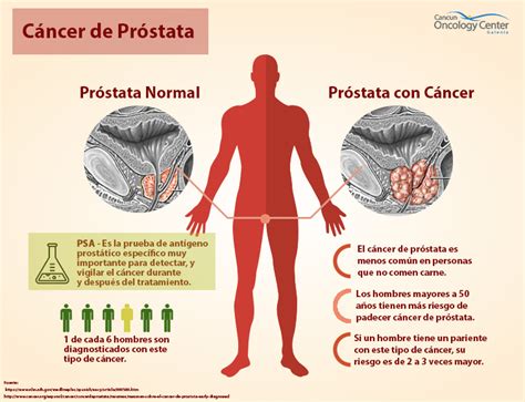 ¿Qué es el Cáncer de Próstata?   Cancun Oncology Center