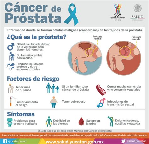 ¿Qué es el cáncer de próstata? | Servicios de Salud de Yucatán