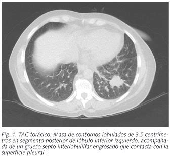 Que es el cancer de pulmon
