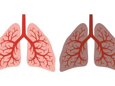 ¿Qué es el cáncer de pulmón?   Síntomas   Roche Pacientes