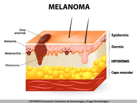 ¿Qué es el Melanoma?   Melanoma: Síntomas, tratamientos