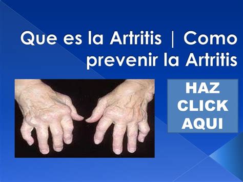 Que es la Artritis | Remedios para la Artritis | Como ...