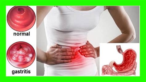 Qué es la Gastritis Antral : Síntomas y TRATAMIENTO   YouTube