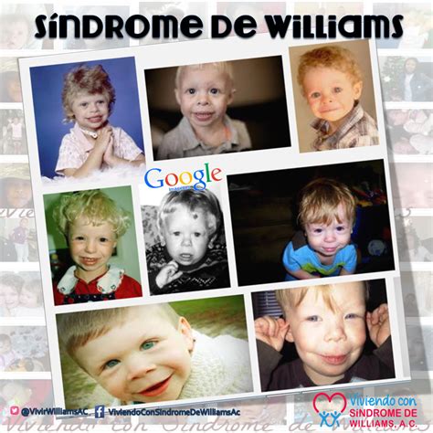 ¿Qué es síndrome de Williams? | Viviendo con síndrome de ...