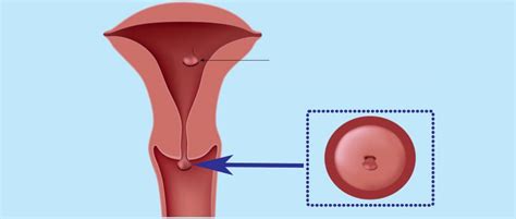 ¿Qué es un pólipo endometrial o uterino?   Síntomas y ...