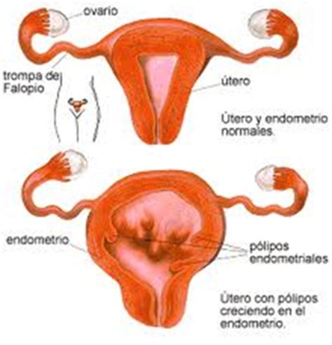 Que Es Un Polipo Endometrial | TUSALUDESVIDA