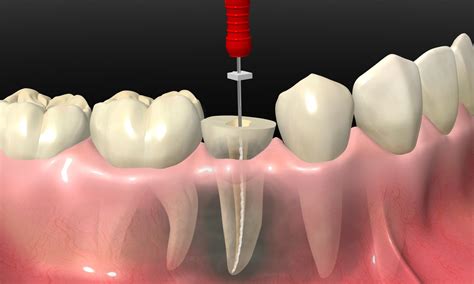 ¿Qué es una endodoncia? | Clínica Dental Alberto Barreiro