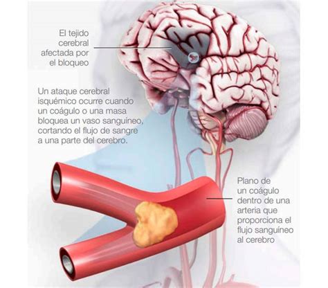 ¿Qué es una isquemia cerebral? | Noticias de Vida Sana en ...