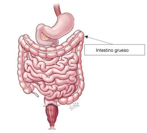 ¿Qué es una obstrucción del intestino grueso?