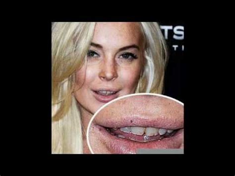 ¿Qué le pasó a Lindsay Lohan en los dientes?   YouTube