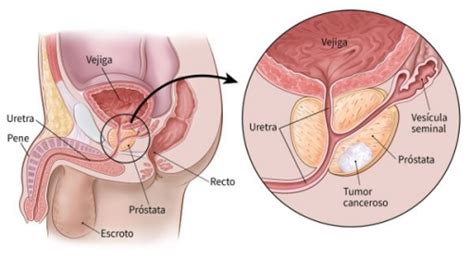 ¿Qué pruebas pueden encontrar temprano el cáncer de próstata?