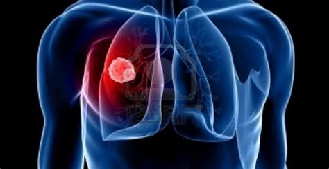 Que sistemas nos alertan sobre el cáncer de pulmón