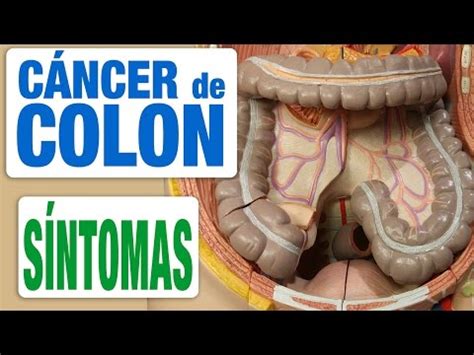 ¿Qué son los pólipos de colon? | FunnyCat.TV