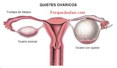 Qué Son Los Quistes De Ovario — Cluber