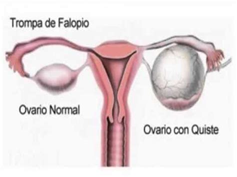 Quistes De Ovario Torcidos Complicaciones Y Sus Síntomas ...