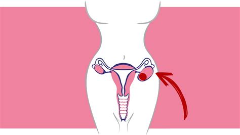 Quistes de ovarios | Tratamiento por laparoscopia