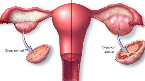 Quistes en los Ovarios ⇒ 【↓Síntomas y Tratamiento↓】