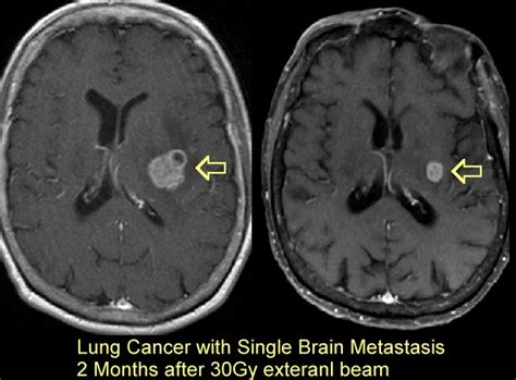 Radiation for Brain Metastases