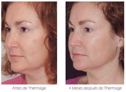 Radiofrecuencia Facial ® » Antes y Después 【con FOTOS