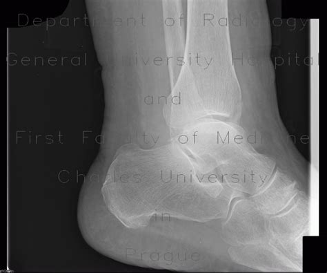 Radiology case: Fracture of tibial malleolus