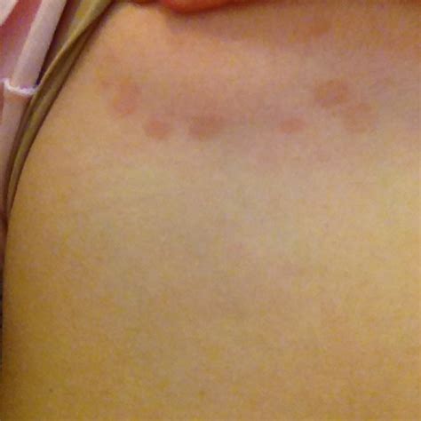 raised brown spots on skin   pictures, photos