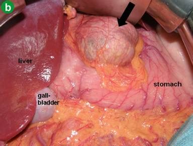 Rare Solid Tumors of the Pancreas as Differential ...