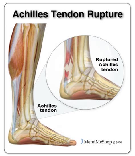 Re injury to your Achilles tendon can create a massive ...