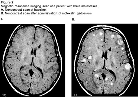 Recent Advances in the Management of Brain Metastases in ...