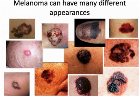 Recognizable Signs and symptoms of skin cancer   TWB