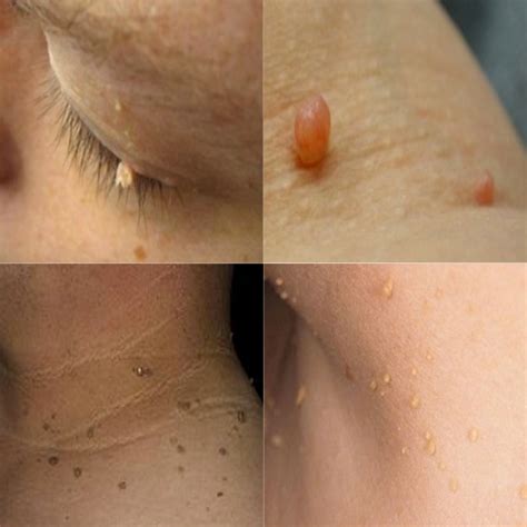 Red spots on skin cancer