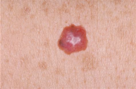 Red spots on skin cancer