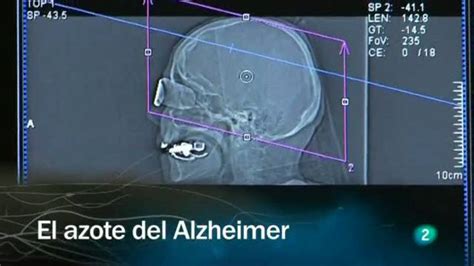 Redes   El azote del Alzheimer   RTVE.es