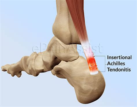 Related Keywords & Suggestions for inflamed achilles ...