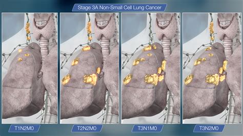 Related Keywords & Suggestions for inoperable stage 4 lung ...