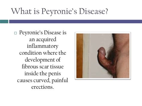 Related Keywords & Suggestions for Peyronie s Disease