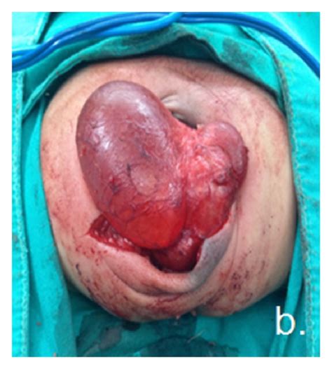Related Keywords & Suggestions for Sacrococcygeal Teratoma