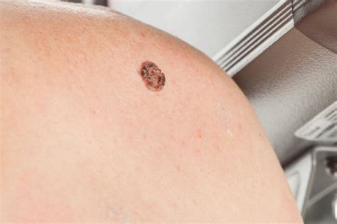 Remedios caseros para evitar los melanomas   ViviendoSanos.com