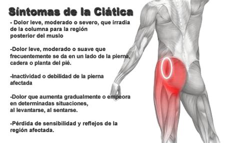 Remedios Caseros Para La Ciatica Lumbar | Ciatica Remedios ...