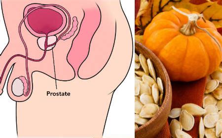 Remedios caseros para la próstata inflamada   Muchos Trucos