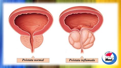 Remedios caseros para la prostata inflamada o prostatitis ...