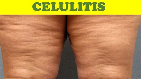 REMEDIOS CASEROS TIPS   CELULITIS  eliminar celulitis ...