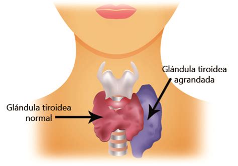 Remedios Naturales para el hipertiroidismo   Terapias Vigo