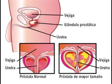 Remedios naturales para tratar la prostatitis  Remedios ...