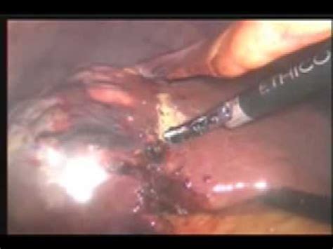 Resección de metástasis hepática por laparoscopia   YouTube